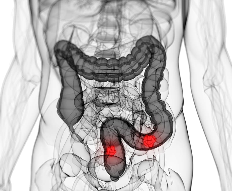 Cuales son los síntomas del cancer de colon. Descúbrelos y estate atento a ellos