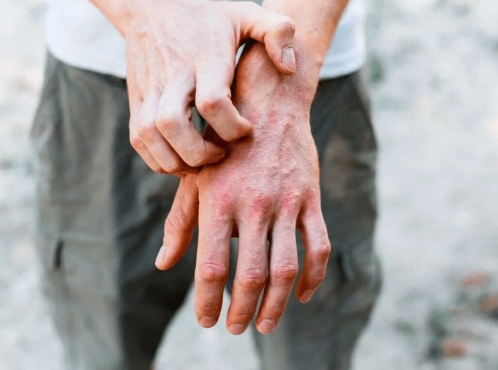 Qué son los sabañones y cómo afectan en verano