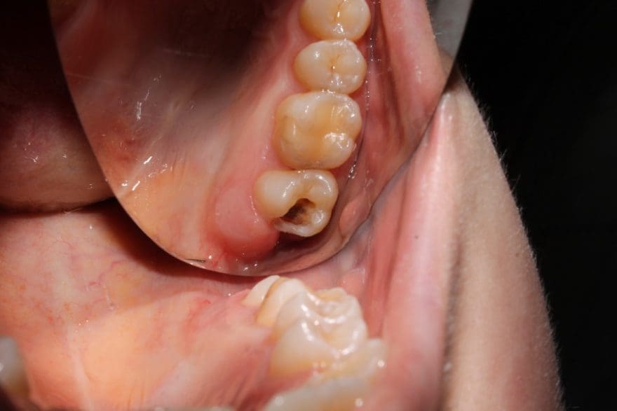 Cómo son los dientes con caries